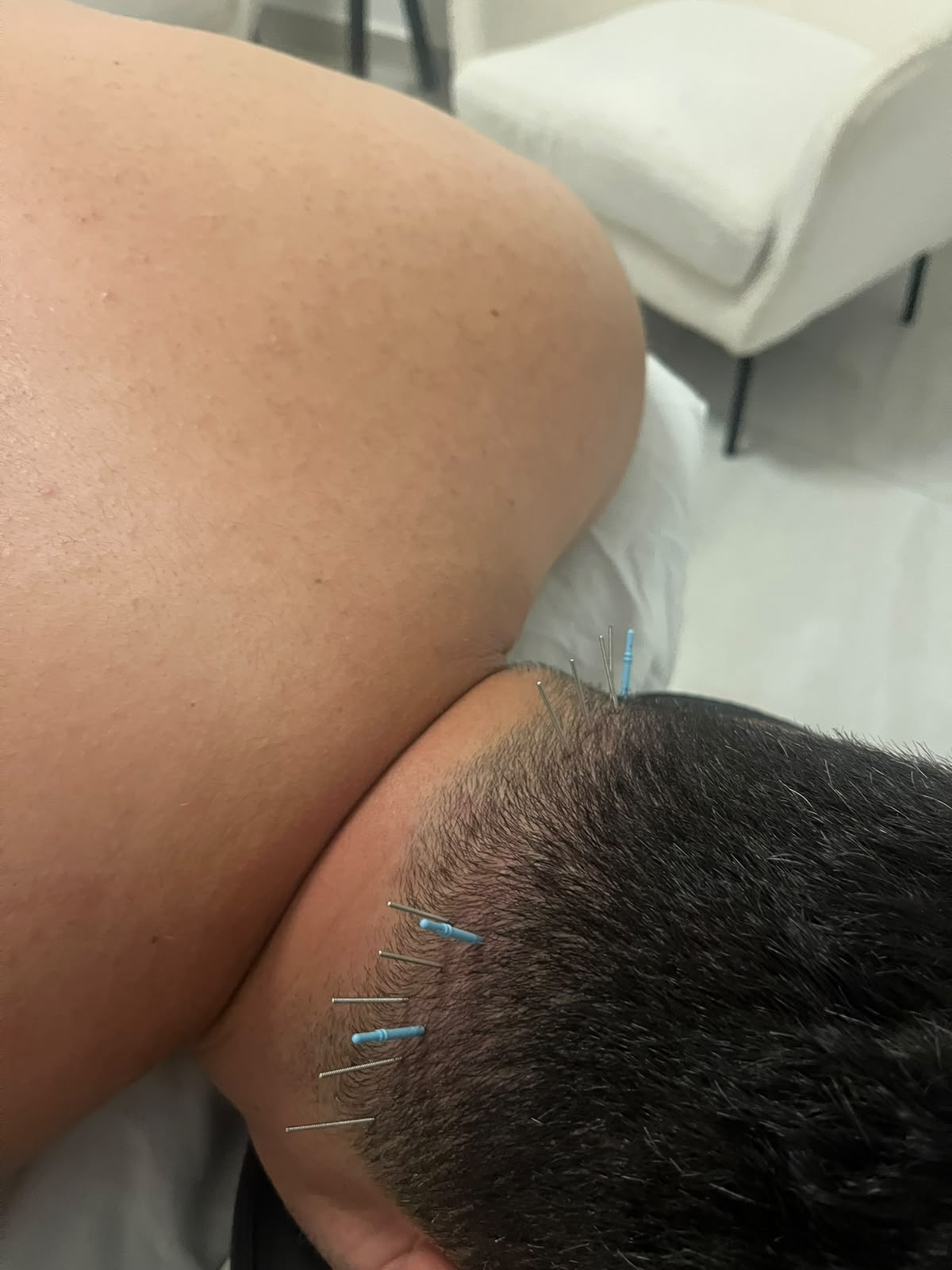 מחטי דיקור יבש בבסיס הגולה ובטרפז העליון