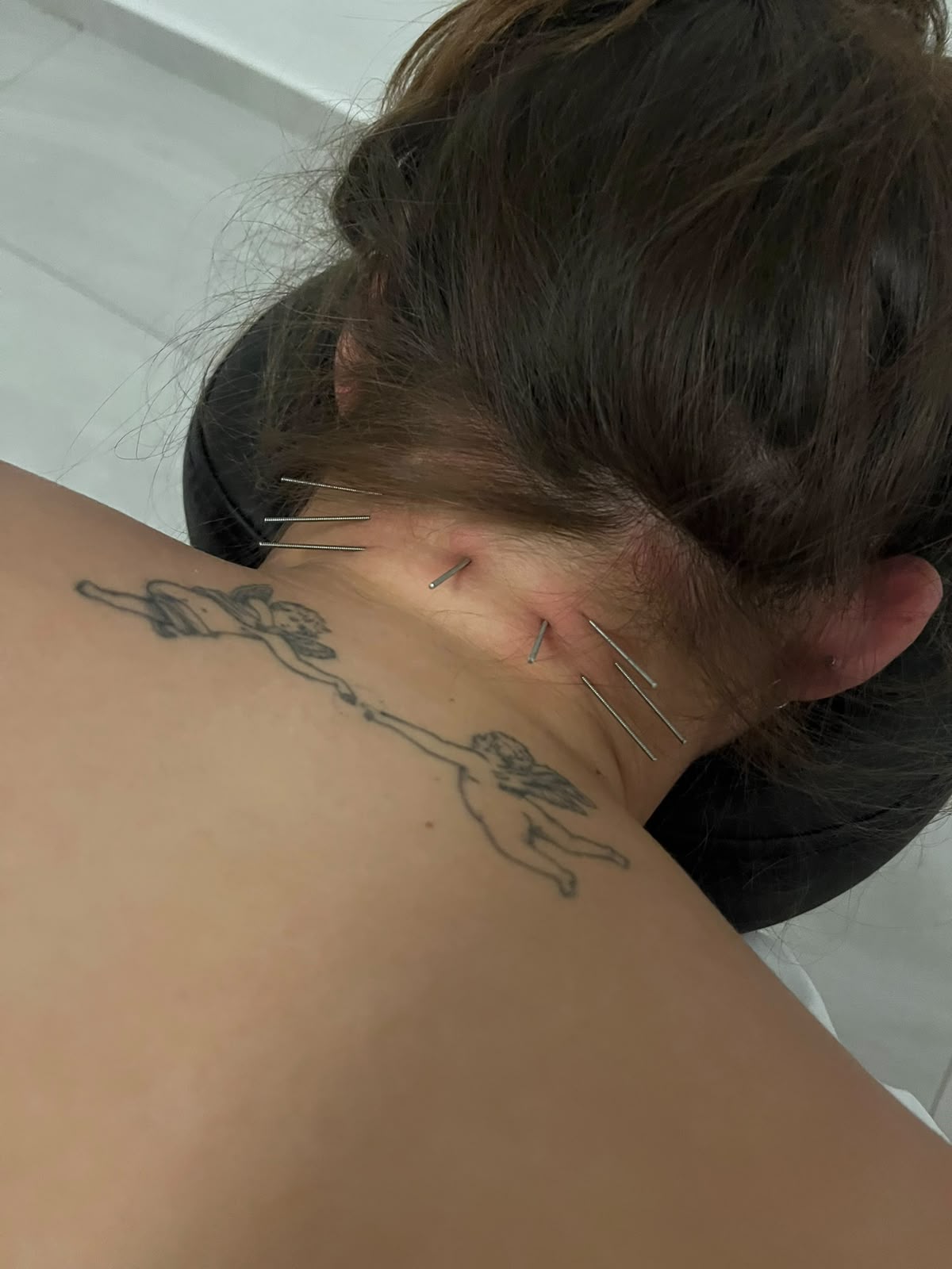 דיקור יבש בשרירי הצוואר האחוריים והכתף