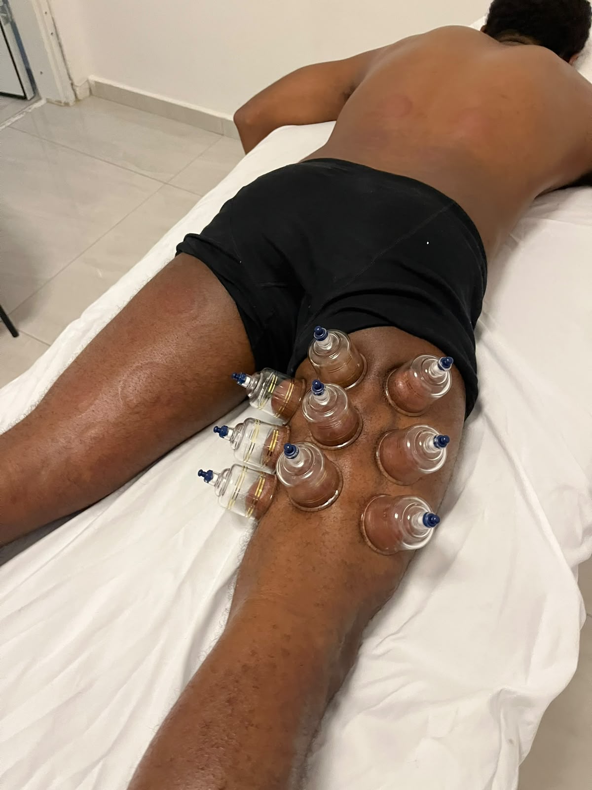 כוסות רוח על שרירי הירך האחוריים והישבן